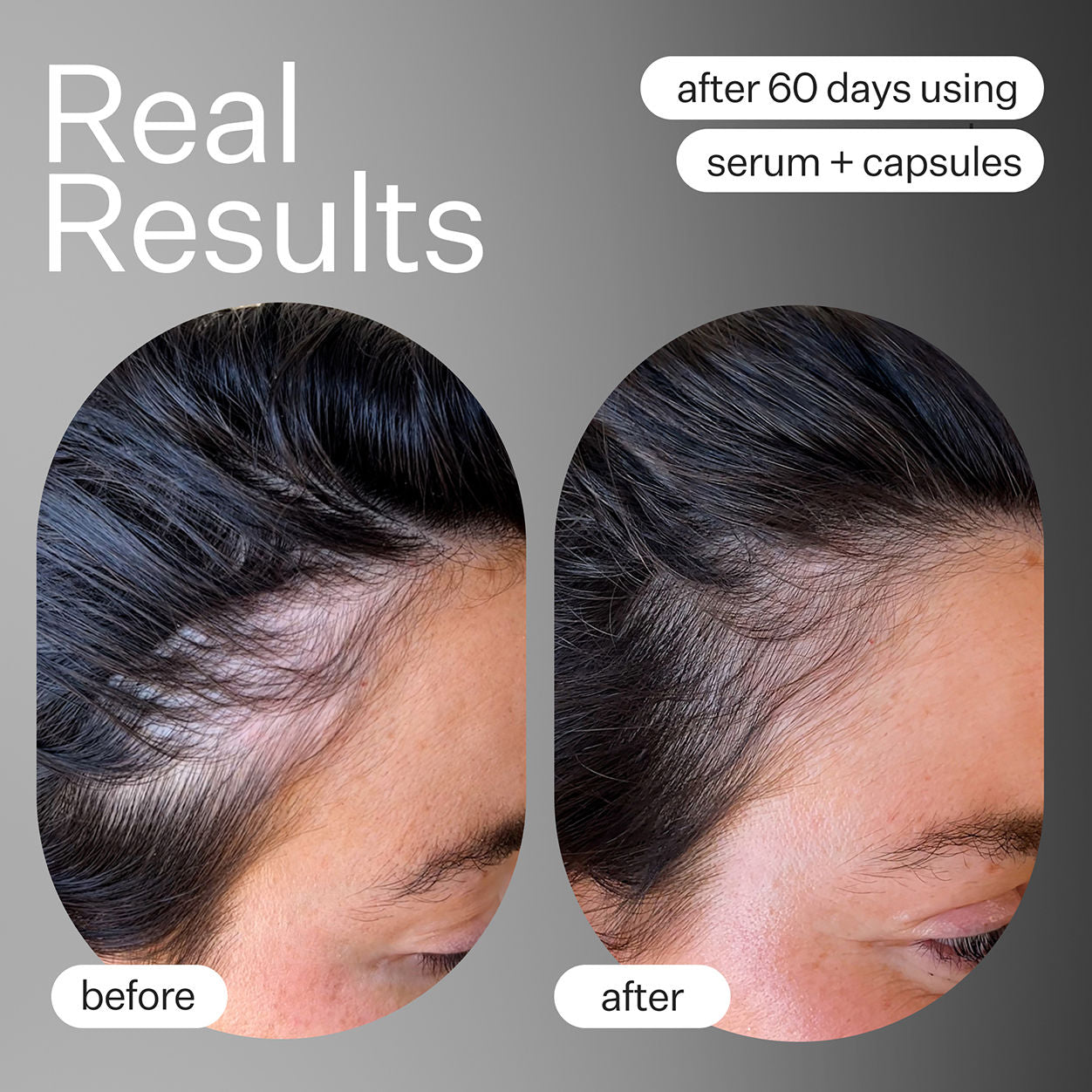 Act+Acre Advanced Fuller Hair System