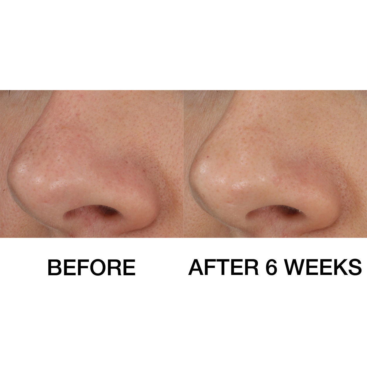 Before and after results of using Clinique Blackhead Solutions Self-Heating Blackhead Extractor