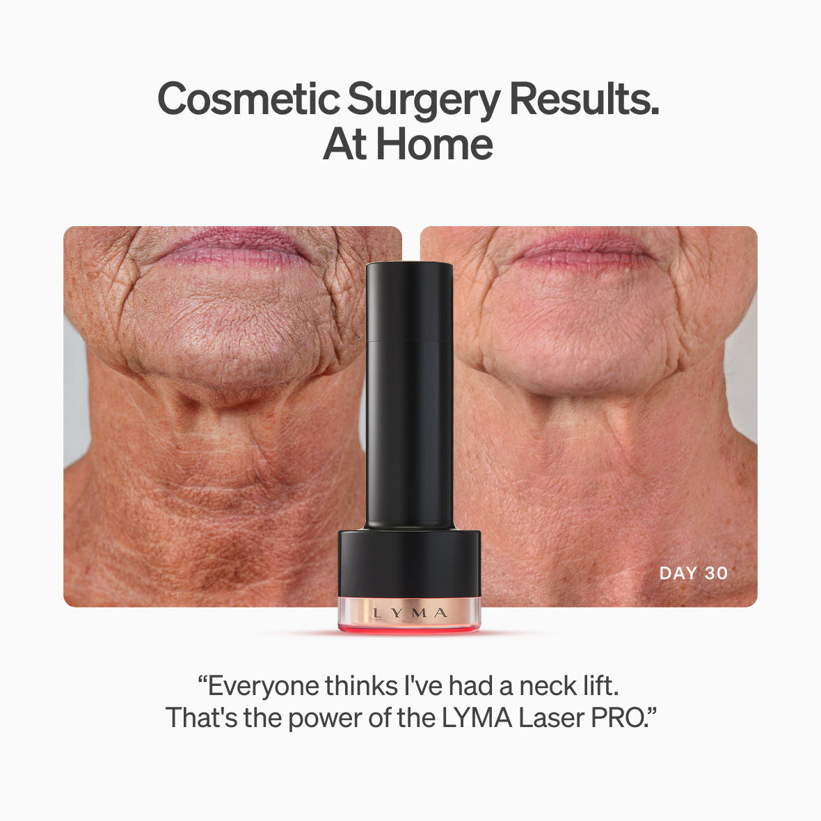 Before and after results of using LYMA LYMA Laser PRO Starter Kit