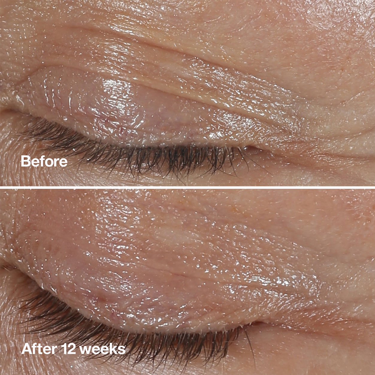 Before and after results of using Clinique Smart Clinical Repair Wrinkle Correcting Eye Cream