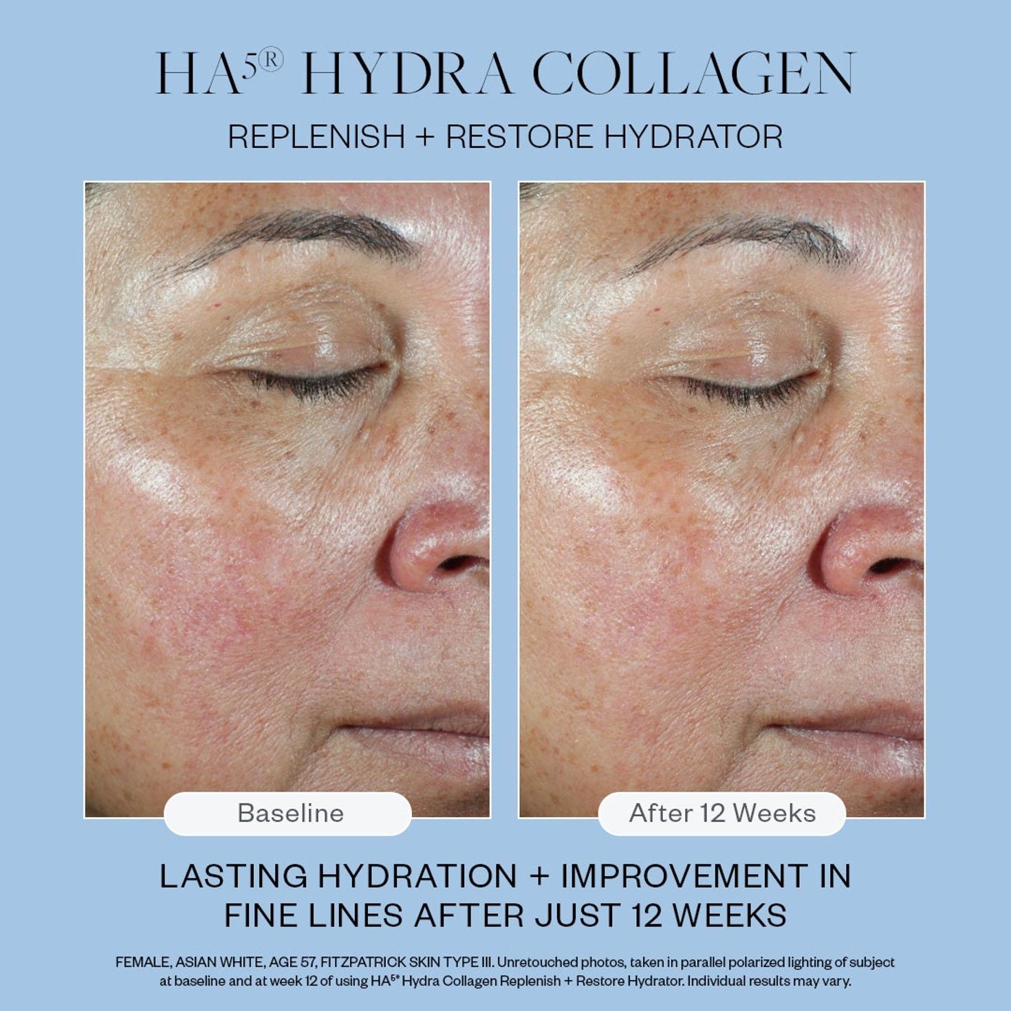 Before and after results of using SkinMedica HA5 Hydra-Collagen Replenish + Restore Hydrator