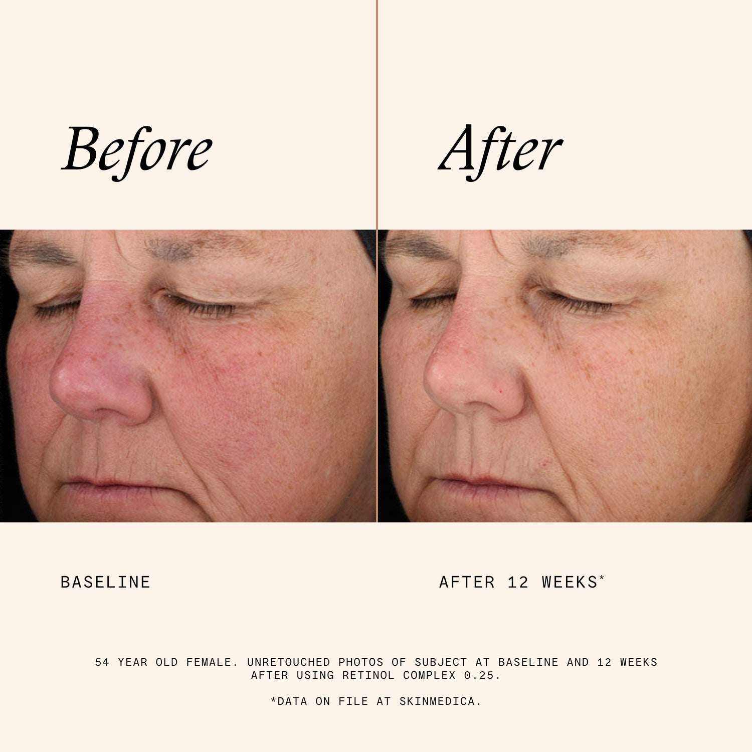 Lifestyle image of SkinMedica Retinol Complex 0.25