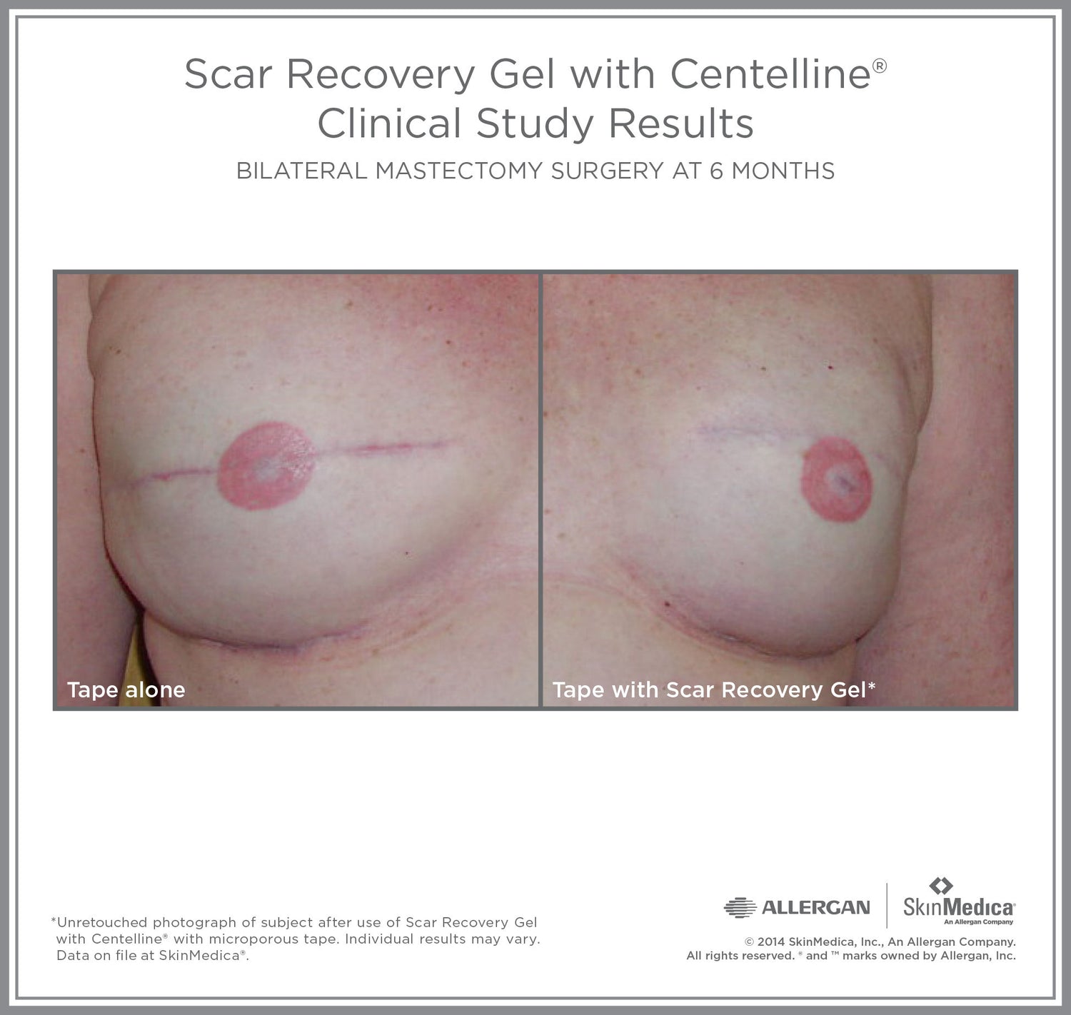 Before and after results of using SkinMedica Scar Recovery Gel with Centelline