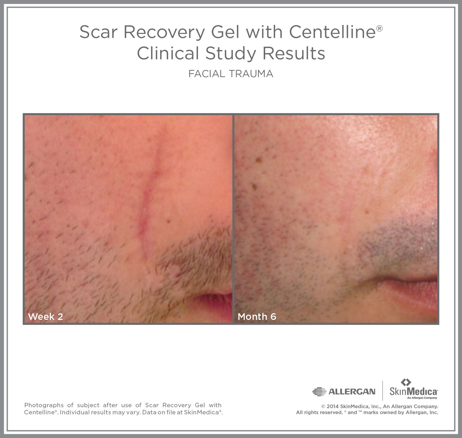Before and after results of using SkinMedica Scar Recovery Gel with Centelline