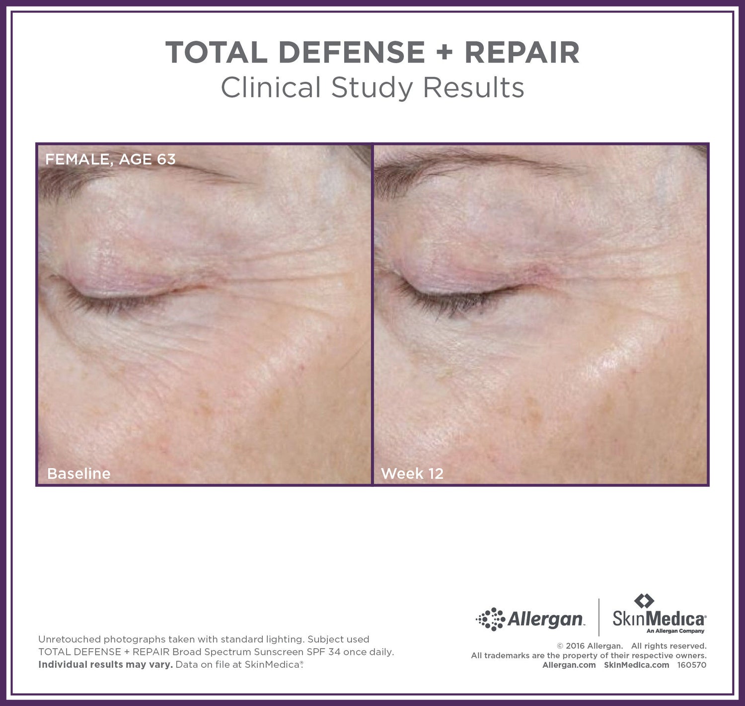 Before and after results of using SkinMedica Total Defense + Repair Broad Spectrum SPF 34 Sunscreen