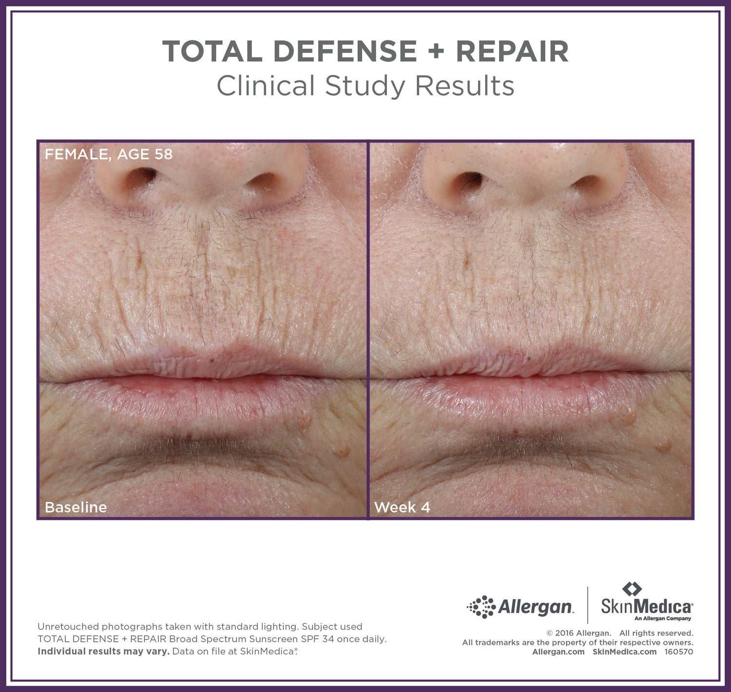 Before and after results of using SkinMedica Total Defense + Repair Broad Spectrum SPF 34 Sunscreen