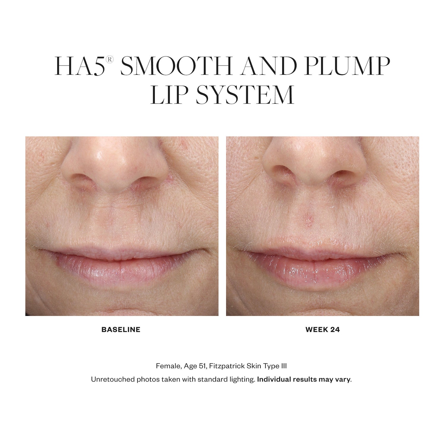 Before and after results of using SkinMedica HA5 Smooth and Plump Lip System