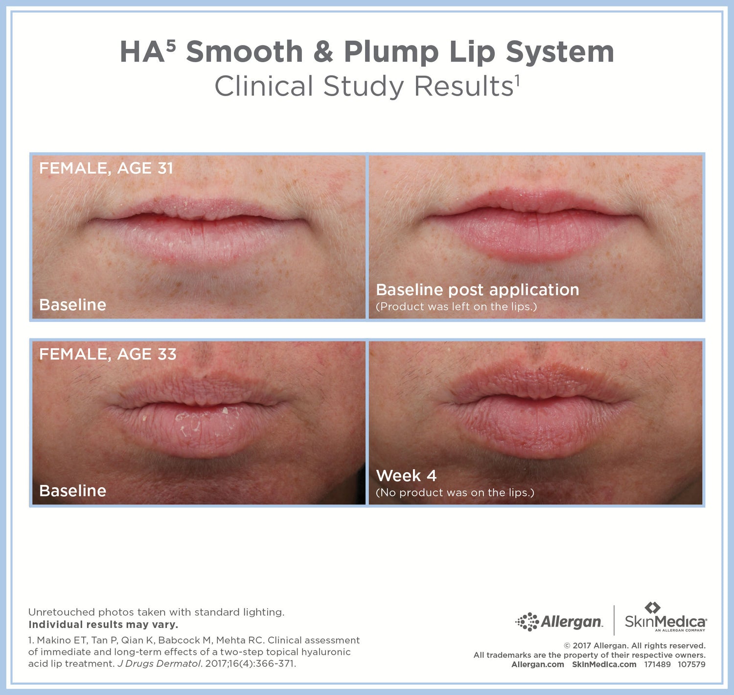 Before and after results of using SkinMedica HA5 Smooth and Plump Lip System