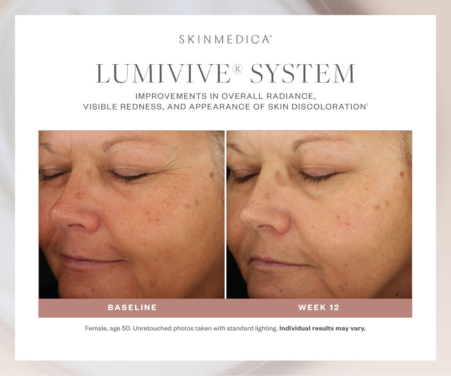 Before and after results of using SkinMedica Lumivive System, Day and Night