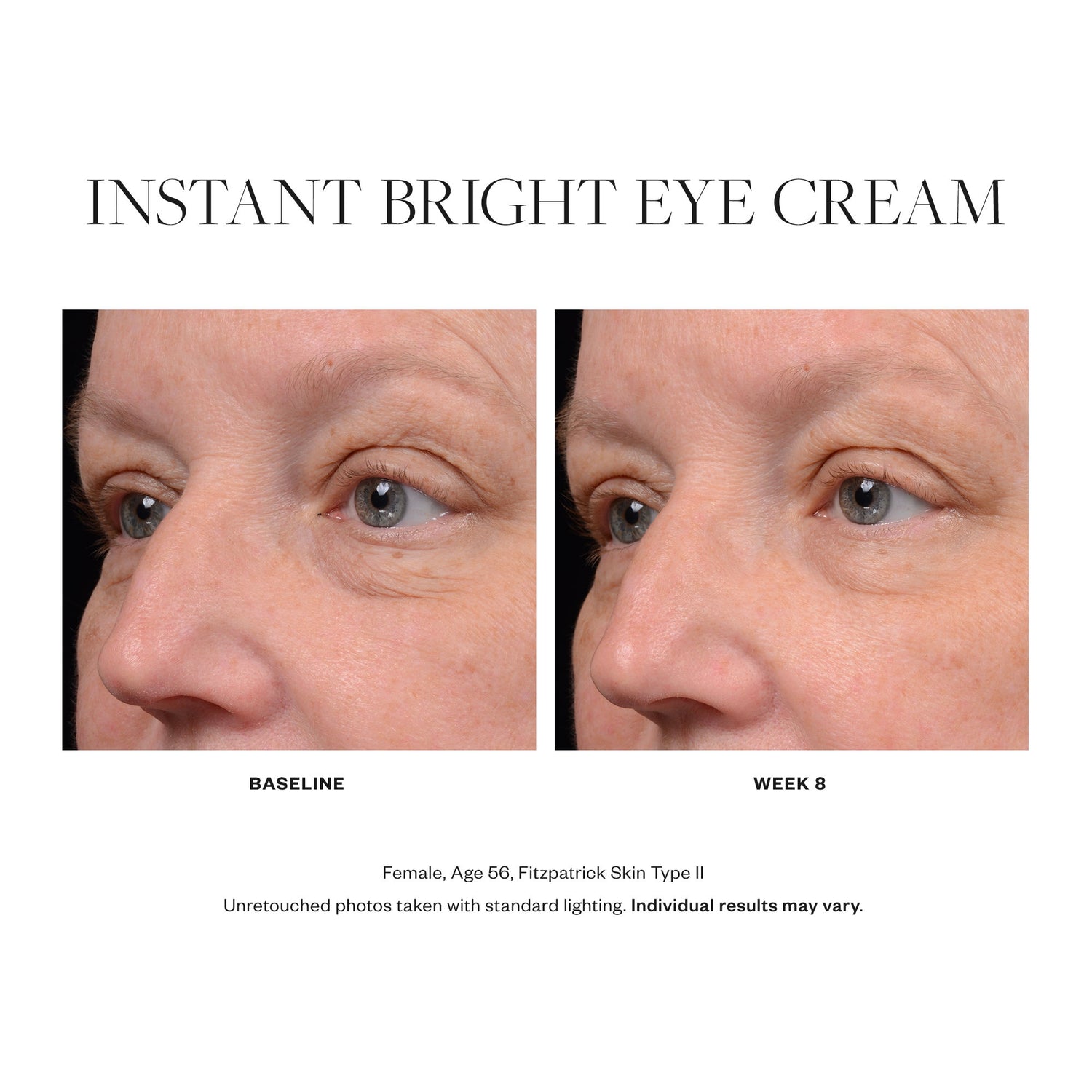 Before and after results of using SkinMedica Instant Bright Eye Cream