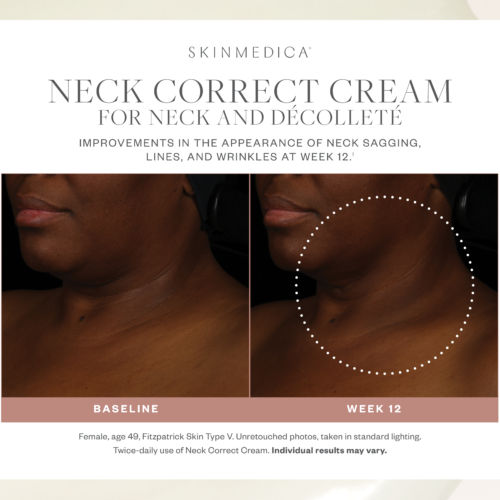 Before and after results of using SkinMedica Neck Correct Cream