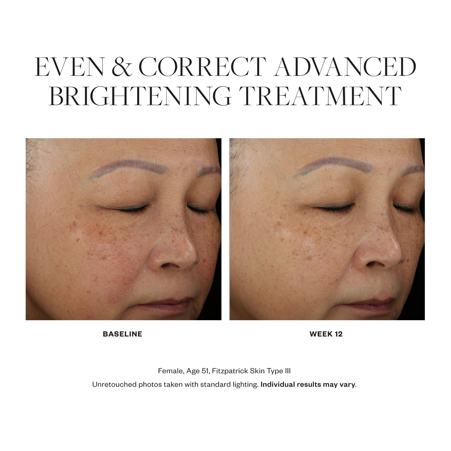 Before and after results of using SkinMedica Even & Correct Advanced Brightening Treatment
