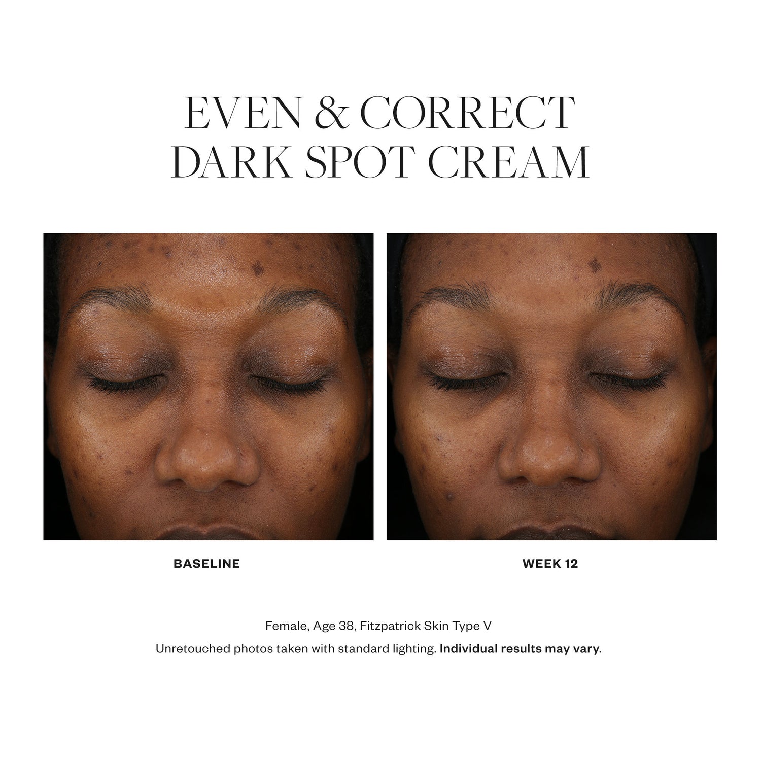 Before and after results of using SkinMedica Even & Correct Dark Spot Cream