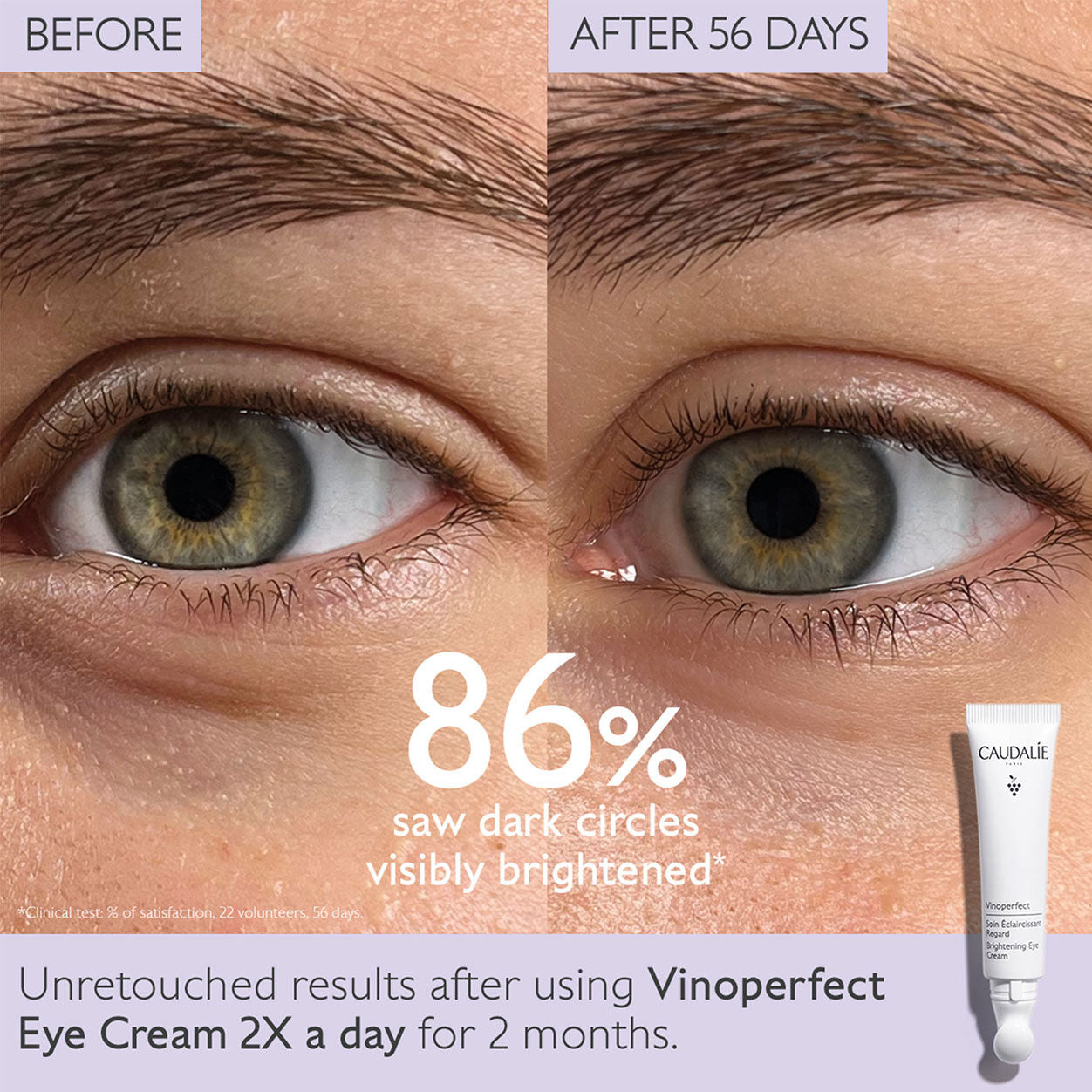 Before and after results of using Caudalie Vinoperfect Dark Circle Brightening Eye Cream