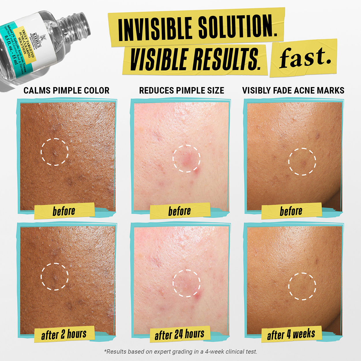 Before and after results of using Kiehl's Since 1851 Truly Targeted Acne-Clearing Solution