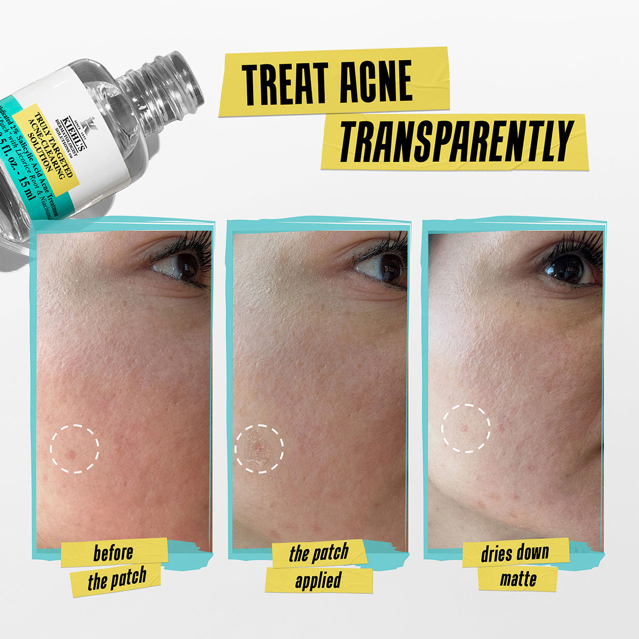 Before and after results of using Kiehl's Since 1851 Truly Targeted Acne-Clearing Solution