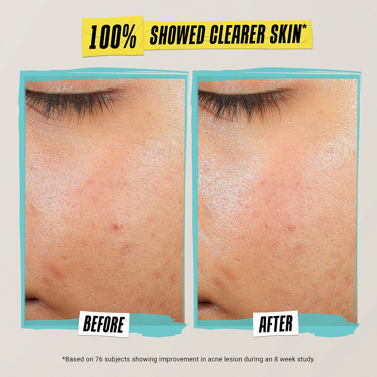 Before and after results of using Kiehl's Since 1851 Expertly Clear Acne-Treating & Preventing Lotion