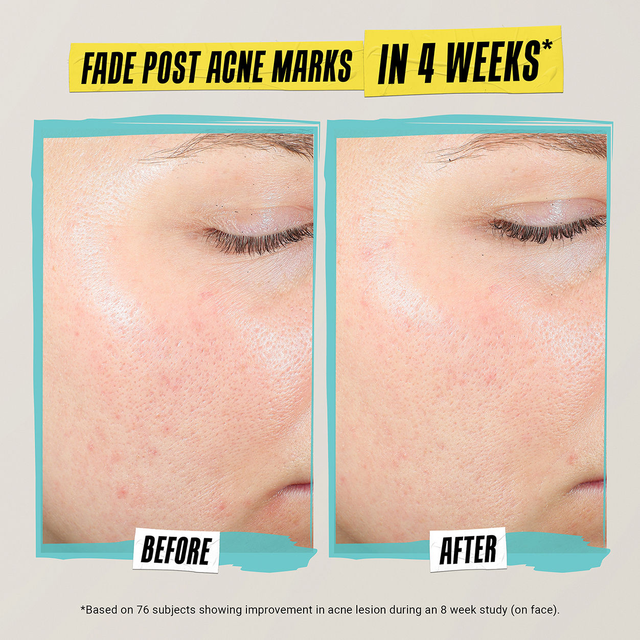 Before and after results of using Kiehl's Since 1851 Expertly Clear Acne-Treating & Preventing Lotion