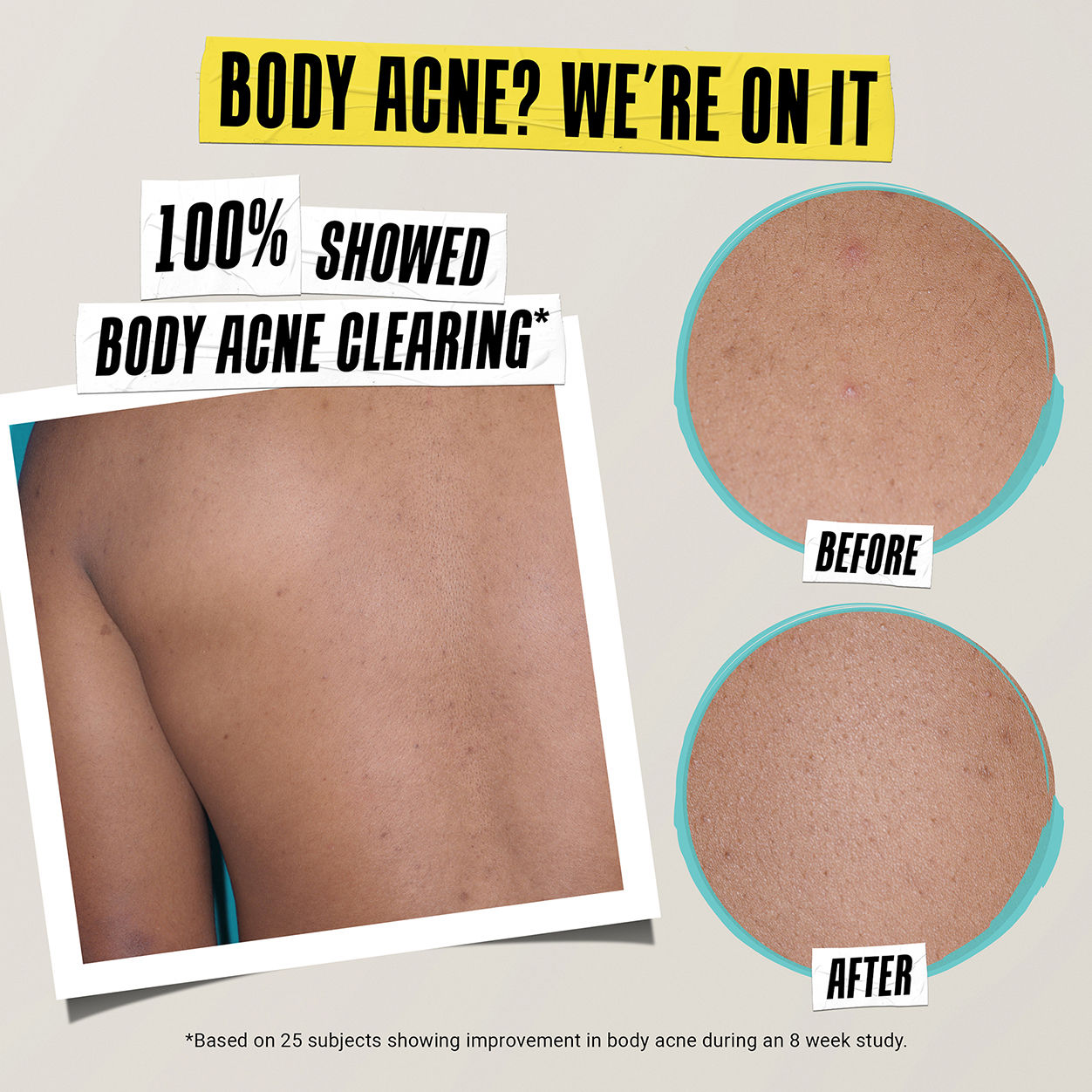 Before and after results of using Kiehl's Since 1851 Expertly Clear Acne-Treating & Preventing Lotion