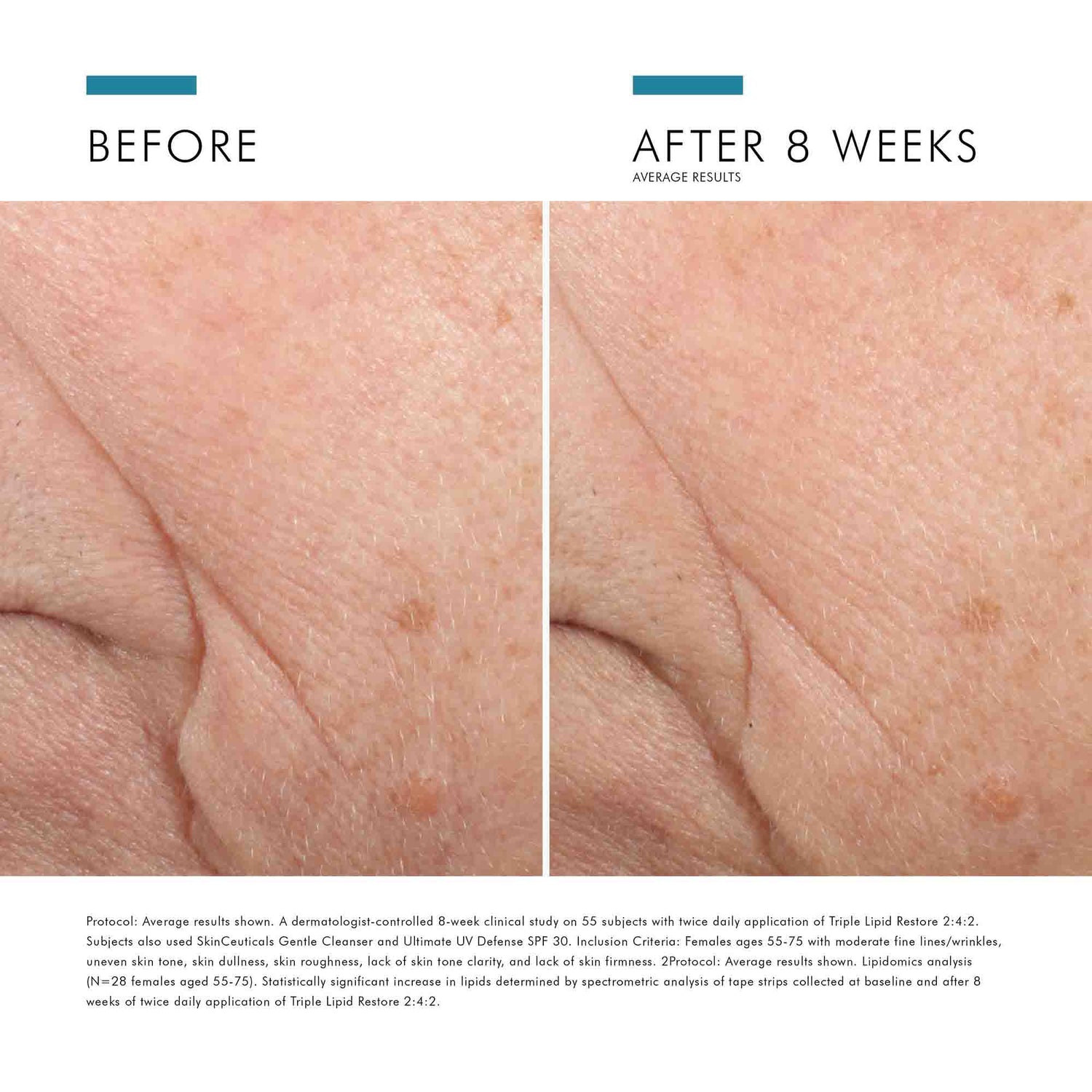 Before and after results of using SkinCeuticals Triple Lipid Restore 2:4:2