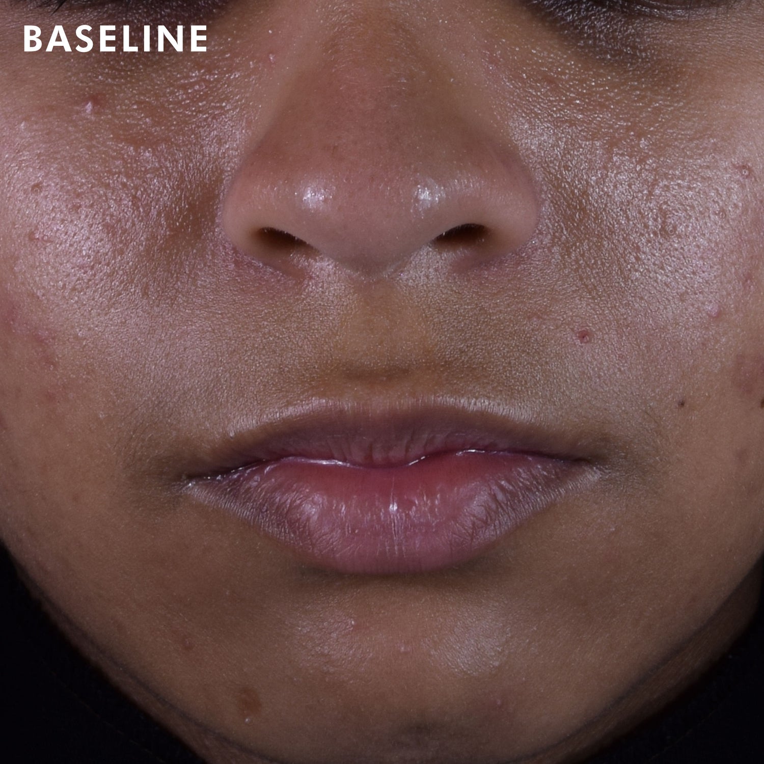 Before and after results of using SkinCeuticals Silymarin CF