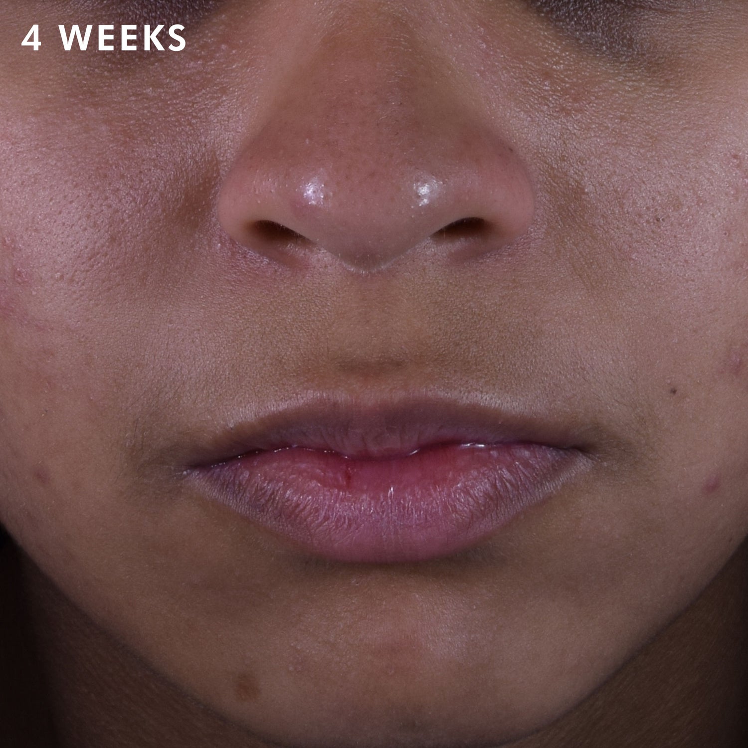 Before and after results of using SkinCeuticals Silymarin CF