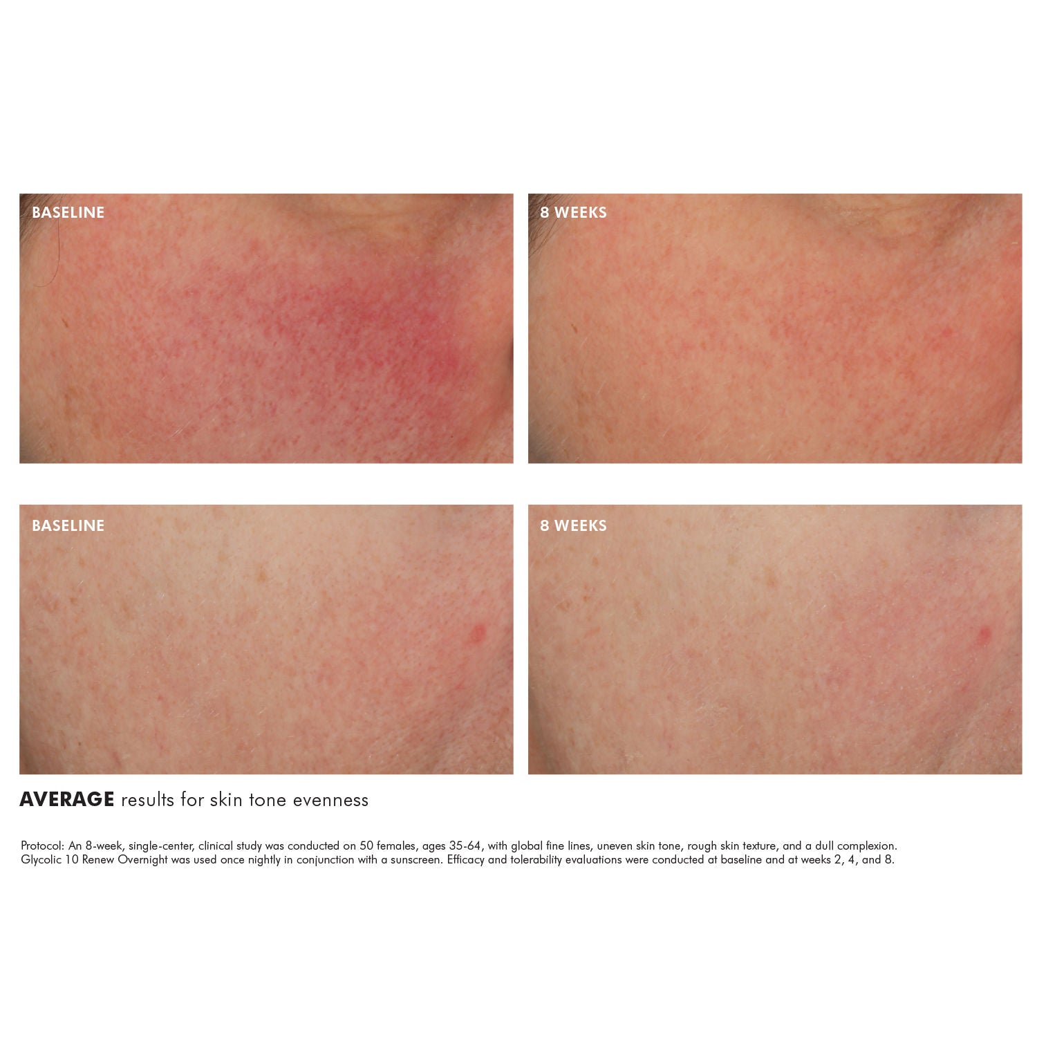 Before and after results of using SkinCeuticals Glycolic 10 Renew Overnight