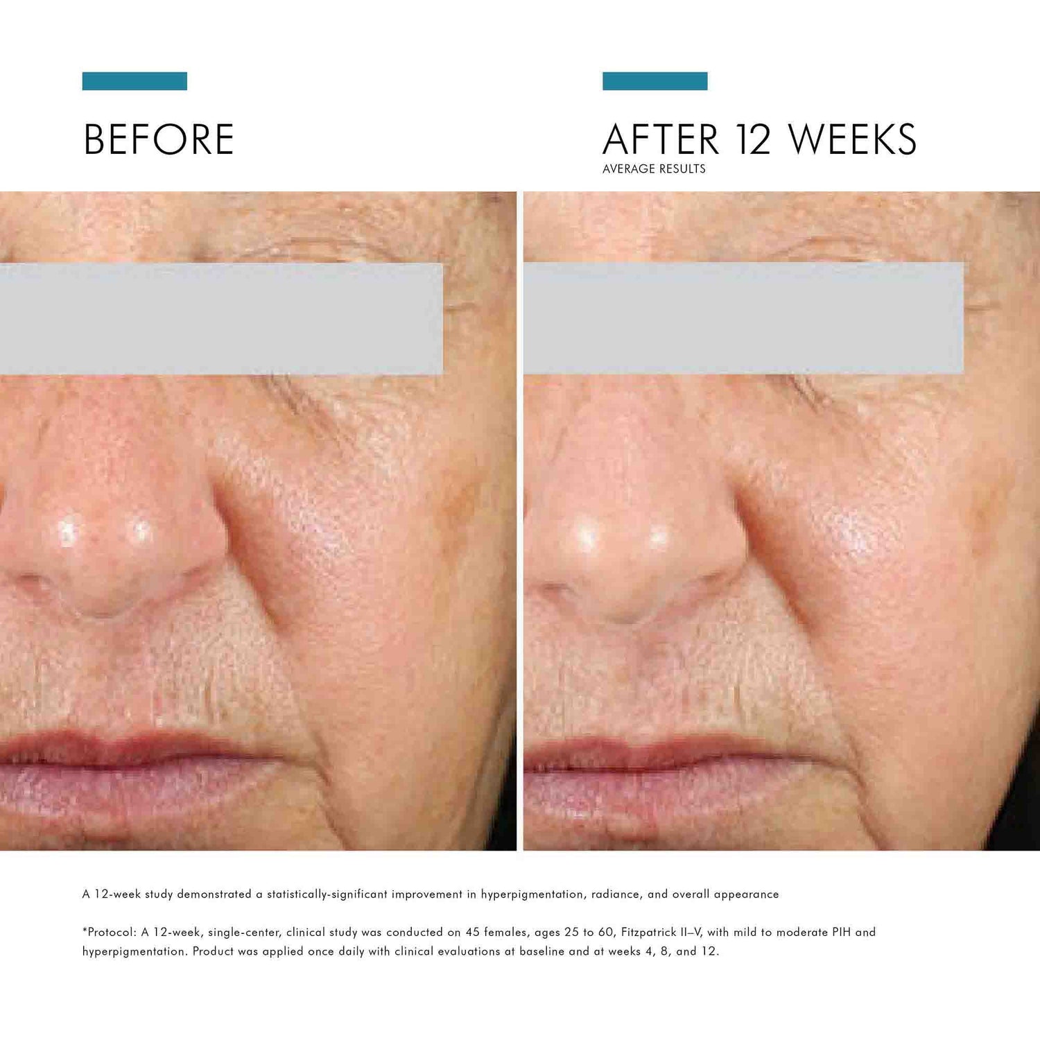 Before and after results of using SkinCeuticals Daily Brightening UV Defense SPF 30