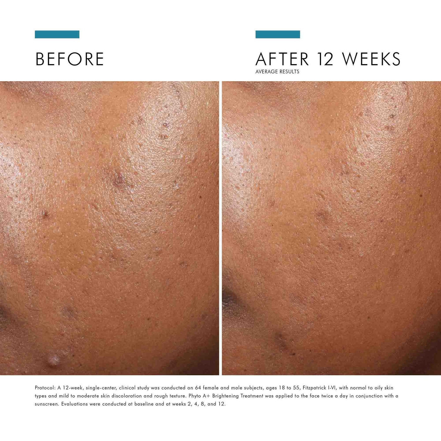 Before and after results of using SkinCeuticals Phyto A+ Brightening Treatment
