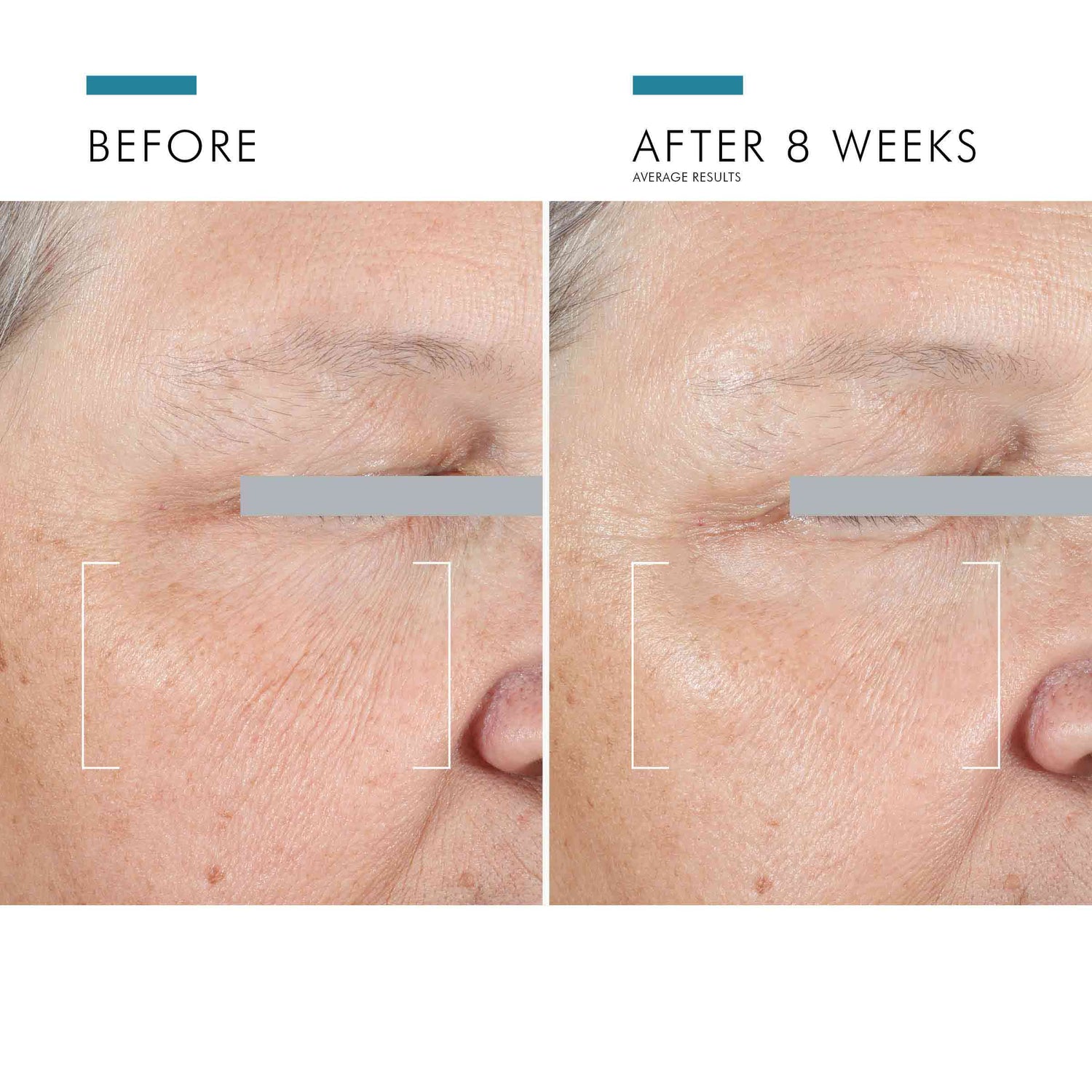 Before and after results of using SkinCeuticals A.G.E. Advanced Eye