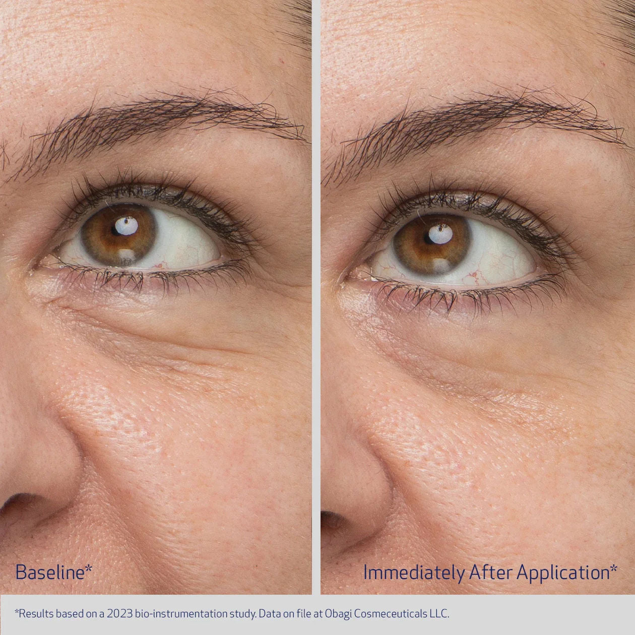Before and after results of using Obagi Daily Hydro-Drops Rejuvenating Eye Gel Cream