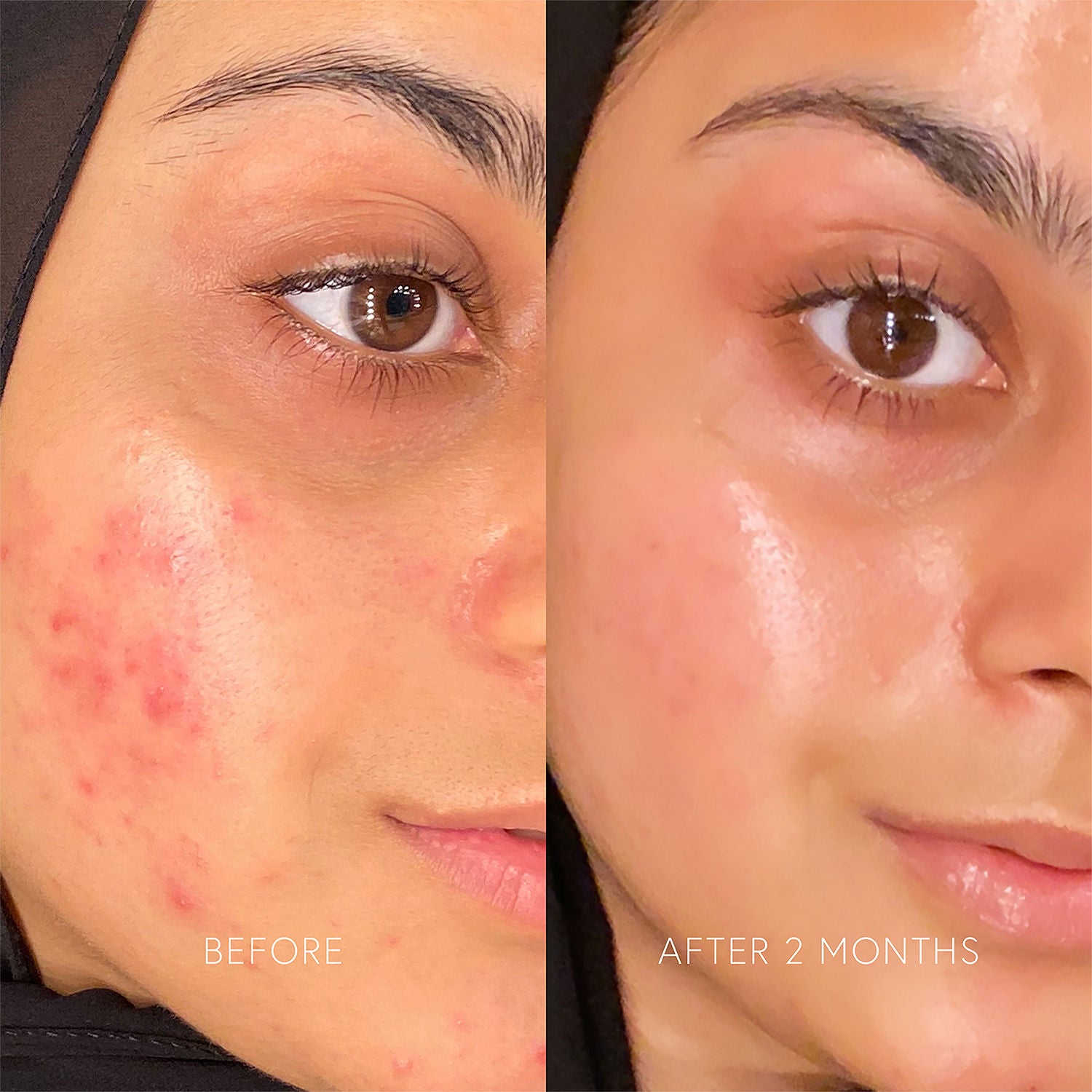 Before and after results of using Dr. Barbara Sturm Enzyme Cleanser