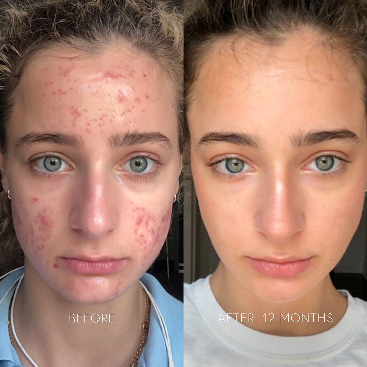 Before and after results of using Dr. Barbara Sturm Clarifying Face Cream