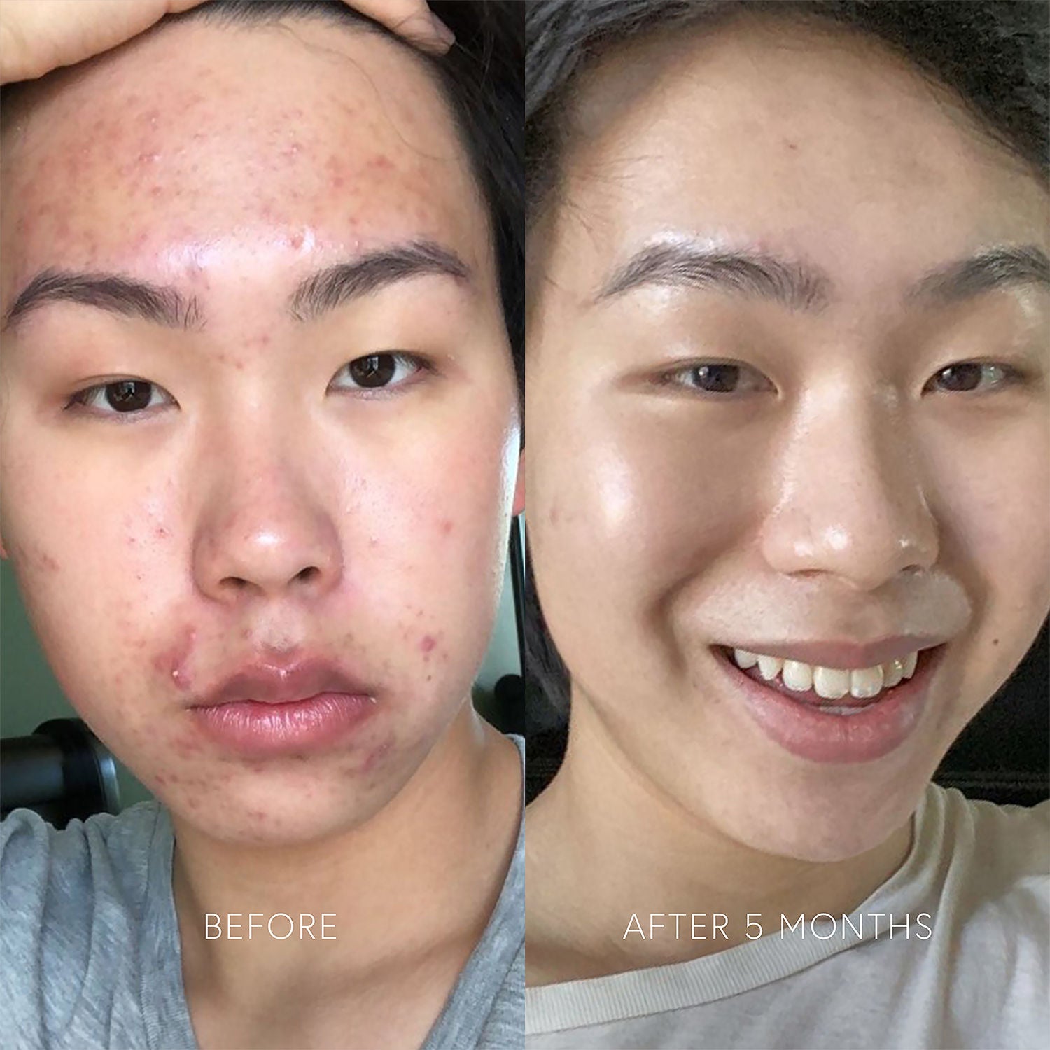Before and after results of using Dr. Barbara Sturm Clarifying Serum
