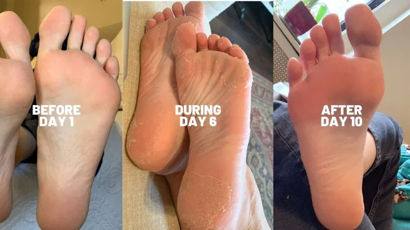 Before and after results of using Baby Foot Spa Bundle