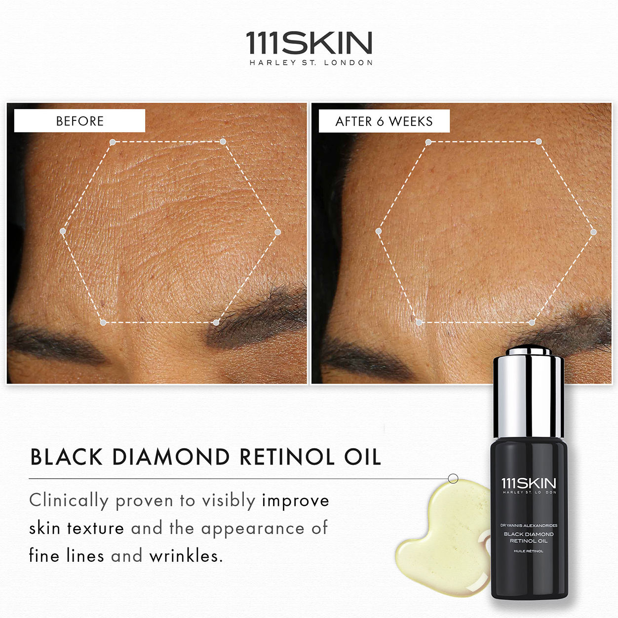 Before and after results of using 111SKIN Black Diamond Retinol Oil
