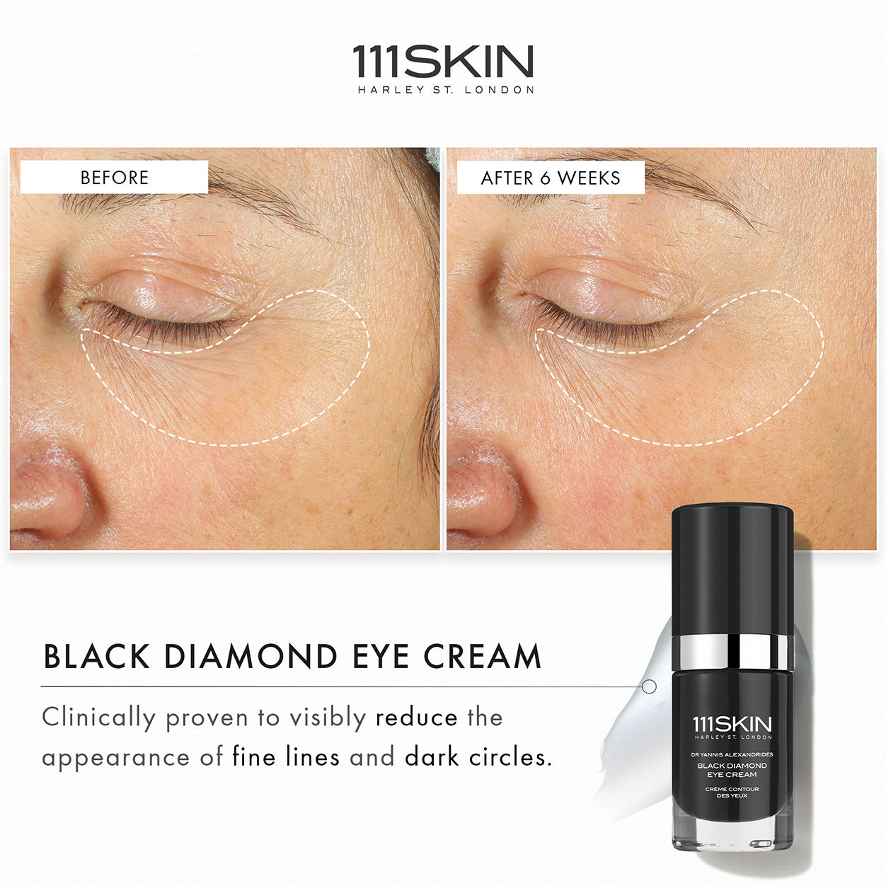 Before and after results of using 111SKIN Black Diamond Eye Cream