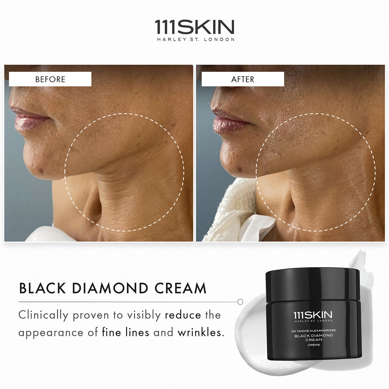 Before and after results of using 111SKIN Black Diamond Cream
