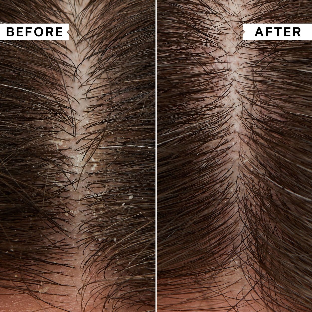 Before and after results of using Philip Kingsley Flaky Scalp Exfoliating Mask