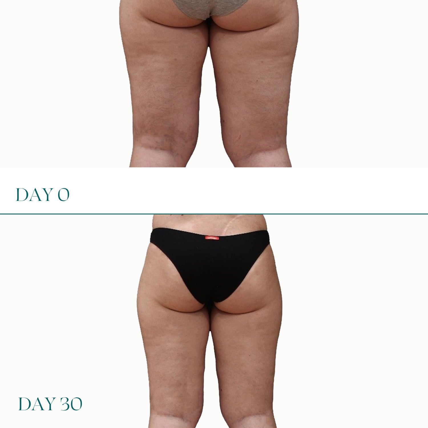 Before and after results of using Legology Cellu-Lite Salon Secret For Legs