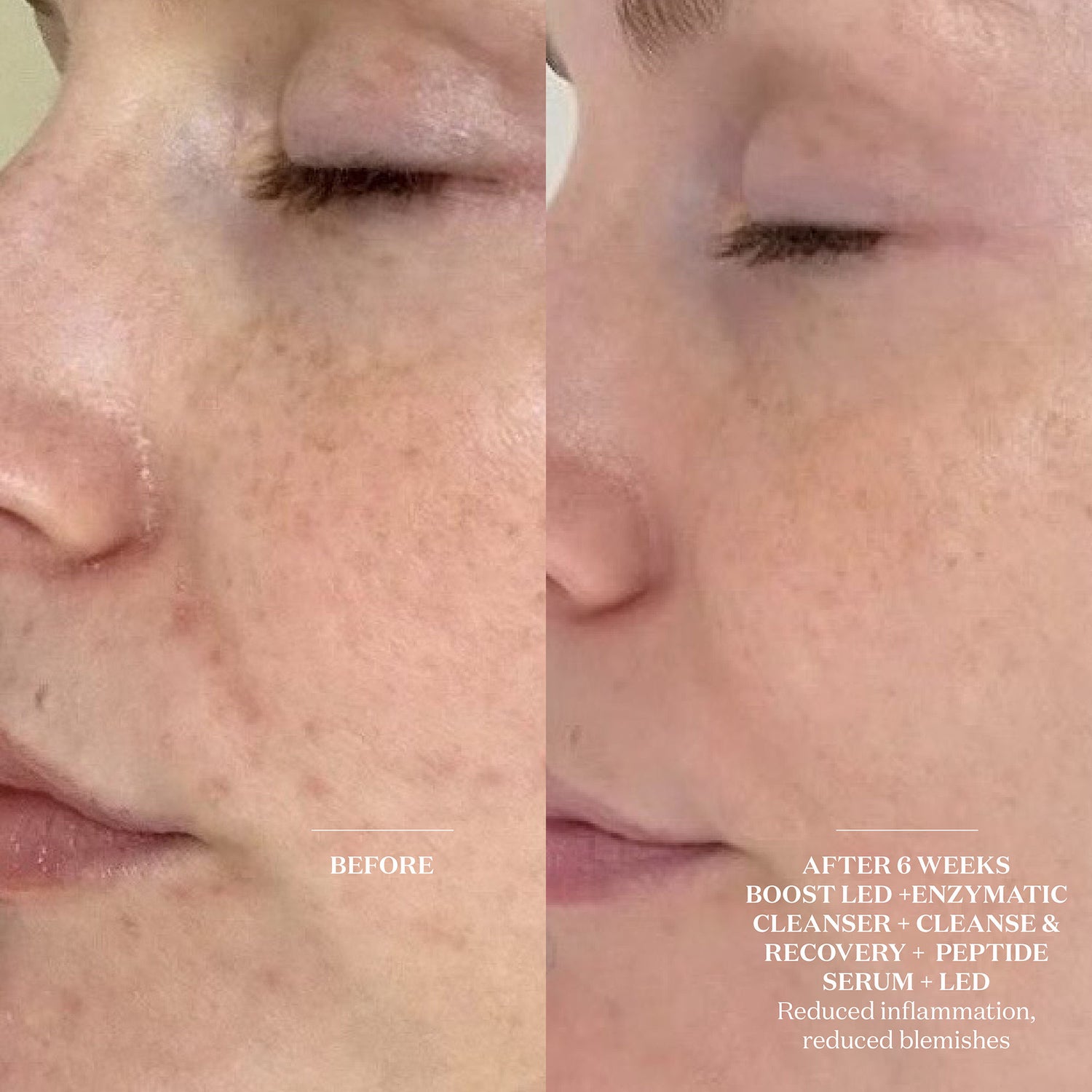 Before and after results of using The Light Salon Boost LED Mask