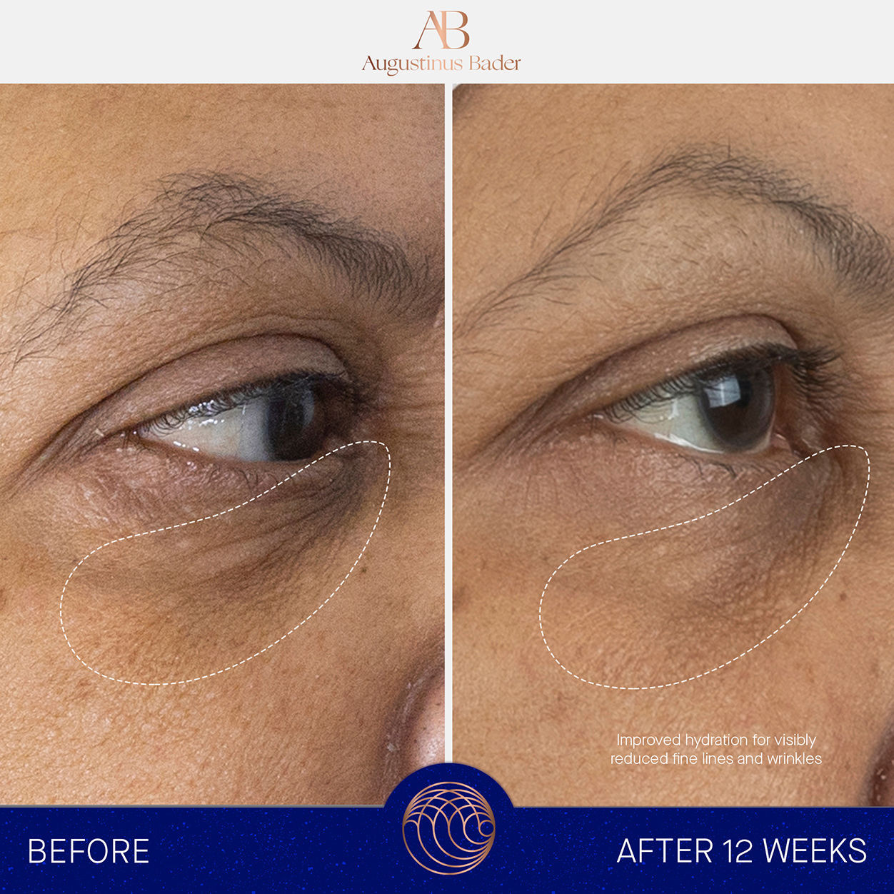 Before and after results of using Augustinus Bader The Eye Cream Nomad