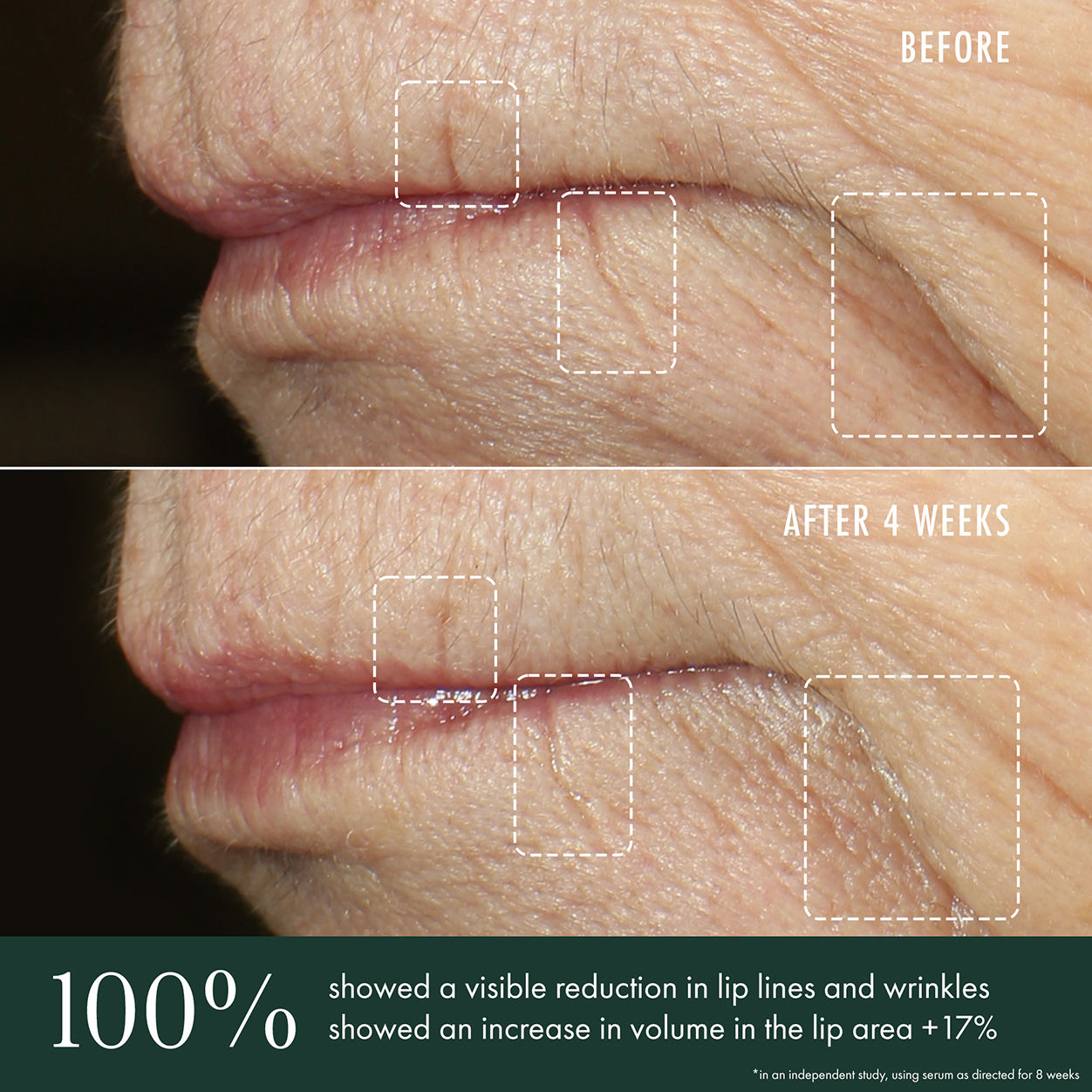 Before and after results of using RéVive Advanced Lip Perioral Serum Targeted Vertical Line Filler