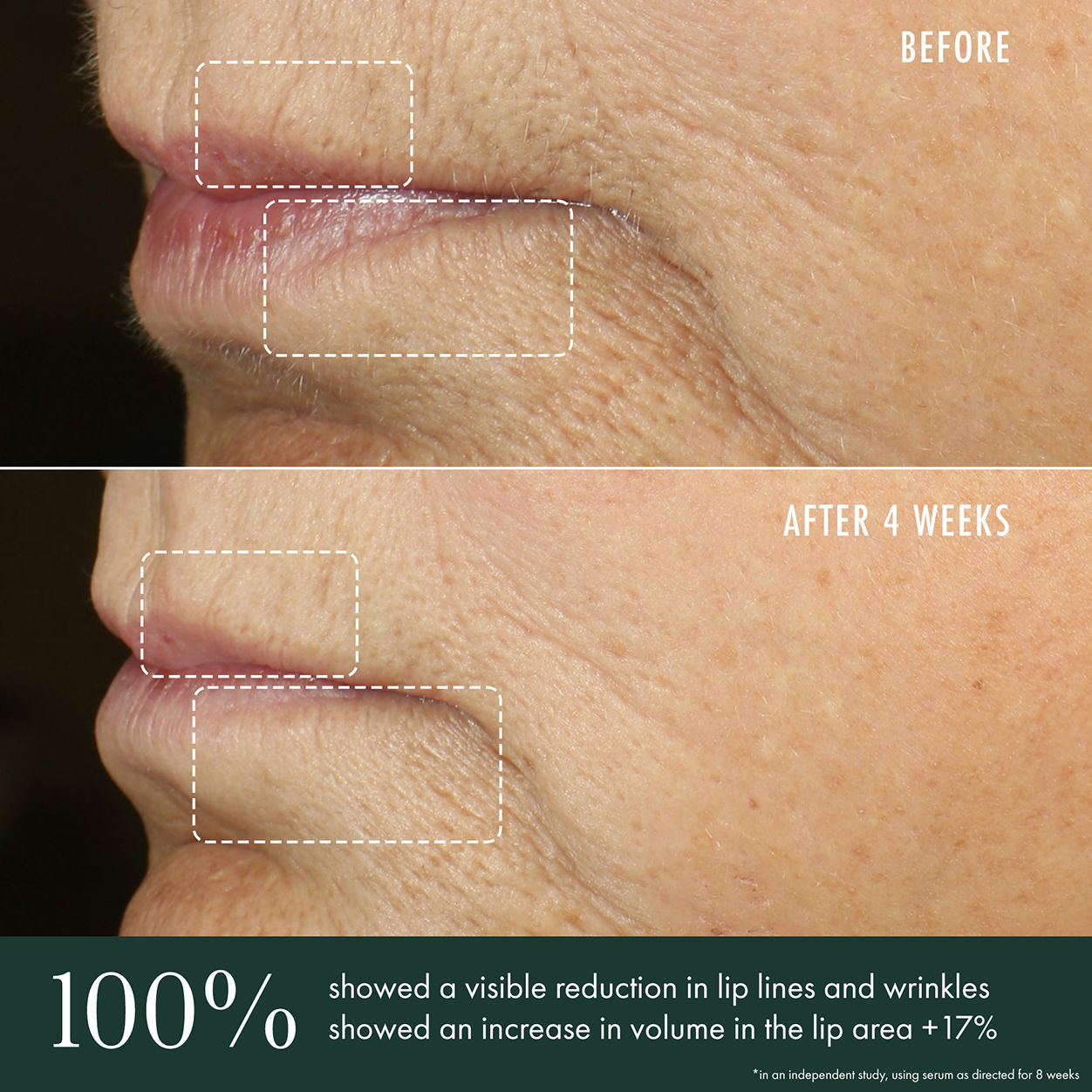 Before and after results of using RéVive Advanced Lip Perioral Serum Targeted Vertical Line Filler