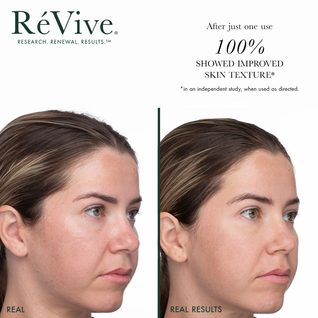 Before and after results of using RéVive Masque De Brilliance Resurfacing Multi-Acid Mask