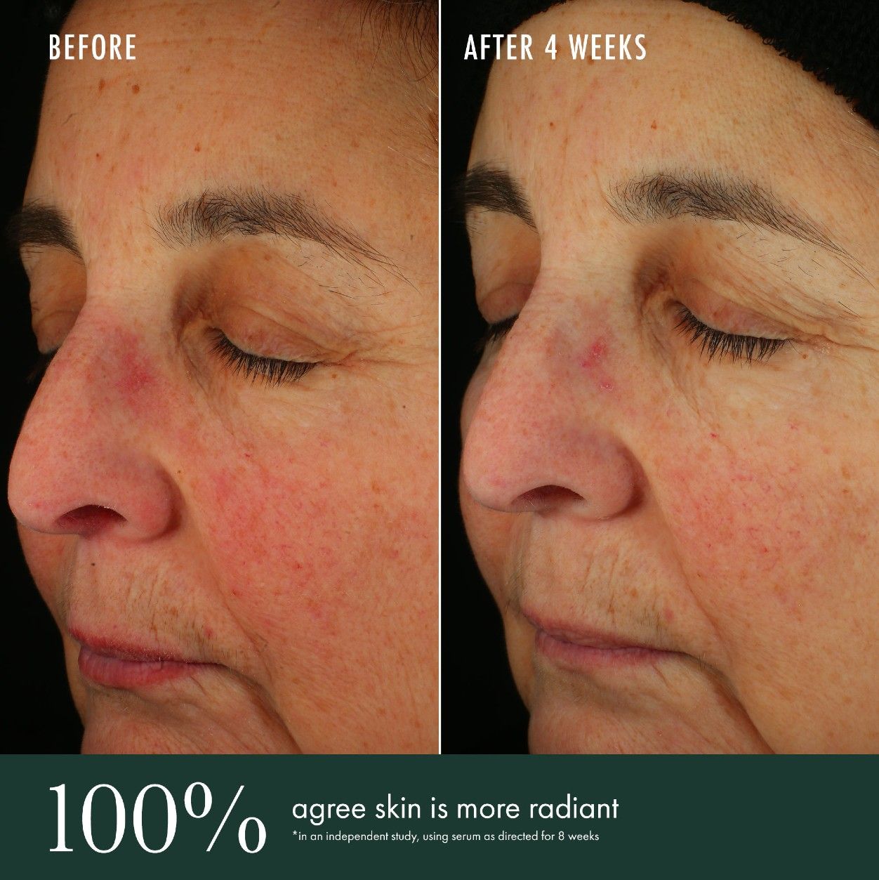 Before and after results of using RéVive Brightening Serum