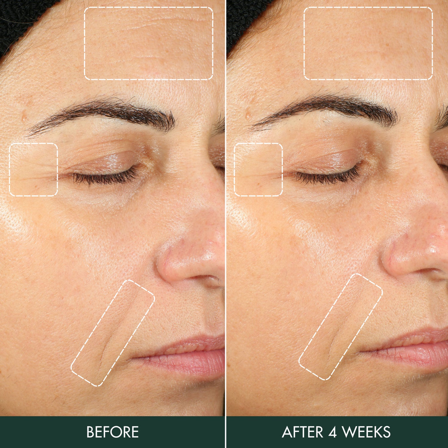 Before and after results of using RéVive Hydrogel Moisturizer