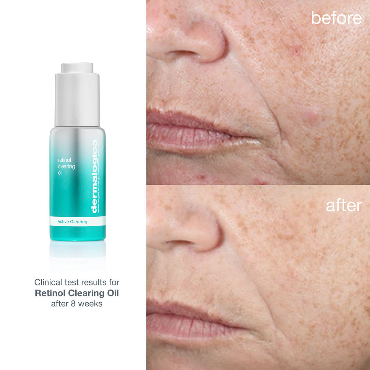 Before and after results of using Dermalogica Retinol Clearing Oil