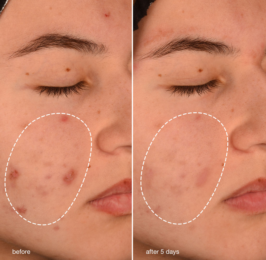 Before and after results of using Dermalogica Acne Biotic Moisturizer
