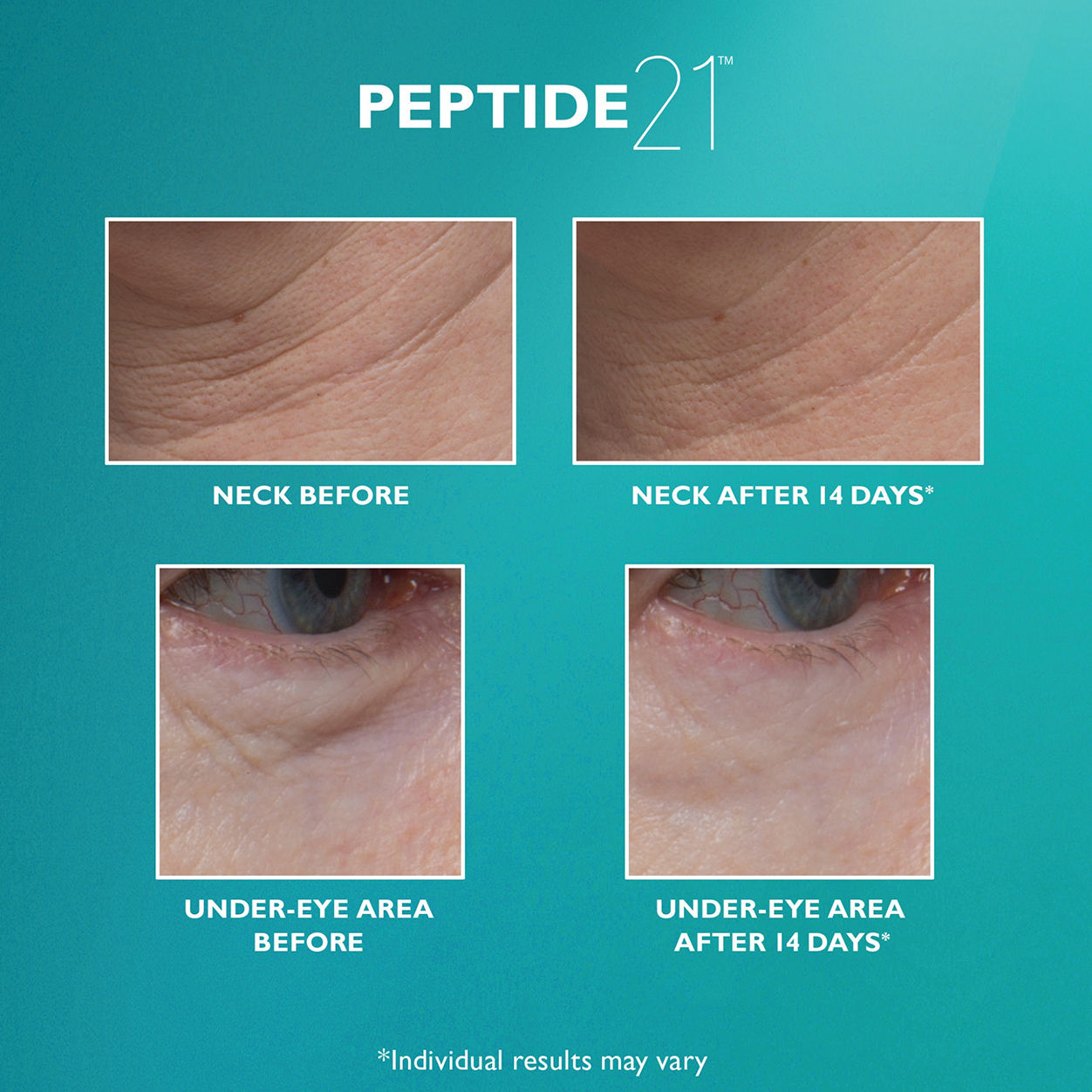 Before and after results of using Peter Thomas Roth Peptide 21 Wrinkle Resist Serum